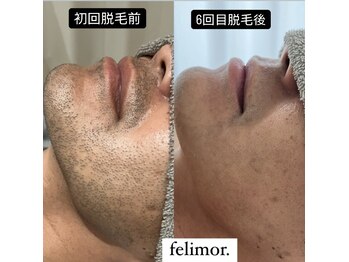 フェリモール(Felimor.)/メンズ光脱毛