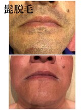 ひとつno武器/メンズヒゲ脱毛