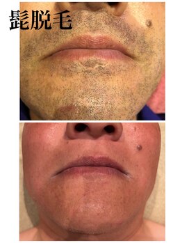 ひとつno武器/メンズヒゲ脱毛