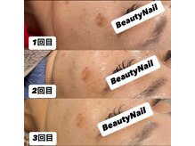 ビューティーネイル(Beauty Nail)/プラズマニア
