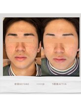 ライフサロン 別府(Life Salon)/ハーブピーリング/毛穴洗浄