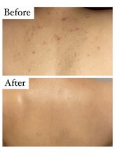 リナート(Rinato)/REVI陶肌ハーブピーリング