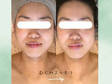 こもれび/1回の施術