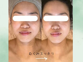 こもれび/1回の施術