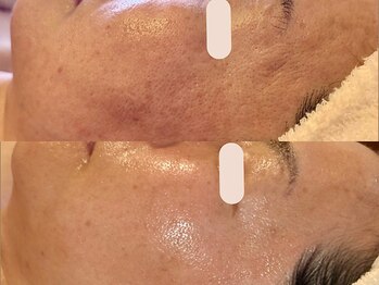 アン(An)/滑らか肌に肌質改善