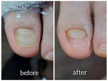 【剥離する爪】