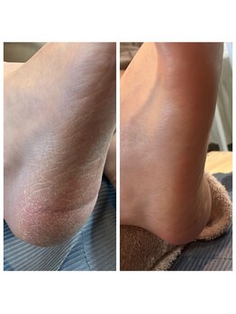 赤ちゃんのようなふわふわ足裏に