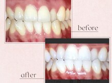 ルアナシンフォニア エクシア 恵比寿店(Luana-Sinfonia)/ホワイトニングビフォーアフター