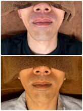 ティアレ 廿日市店(Tiare)/髭　脱毛　ひげ