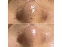 GRACETHOUSAND(グレイスサウザンド)/ハイドラ毛穴洗浄/毛穴吸引/毛穴