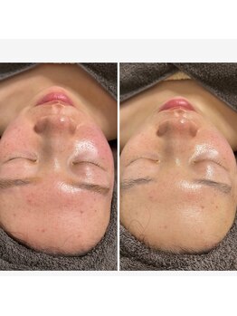 クレセント(CRESCENT)/REVIハーブピーリング1回の効果