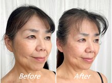 ドクターボディ 新宿店(Dr.Body)/【中顔面短縮/たるみ改善 50代】