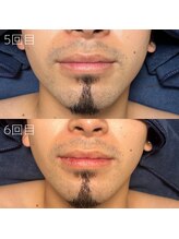 カナウ(KANAU)/ヒゲ脱毛（20代前半男性）