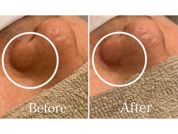 エニ 恵比寿(eni)/毛穴の汚れをごっそりお掃除