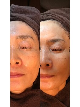 シープ(Sheep)/施術例 1