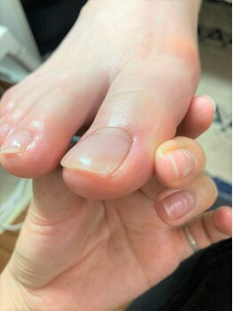 ランランネイル(rangrang nail)の写真/【巻爪補正】巻き爪矯正は痛いというイメージを覆す「綺麗な巻き爪補正」。多くの実績はブログをcheck!