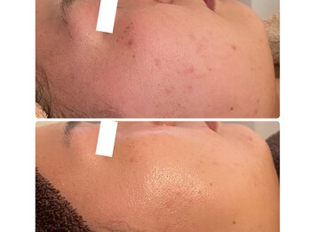 ビジュープラス つくば店(Bijou+)/繰り返すニキビケアに