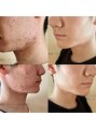 デジール メンズフェイシャル 専門サロンメンズ毛穴ニキビケアメンズ脱毛