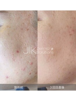 ナチュウル(Natulu)/ララピール進化版！ダクトピール