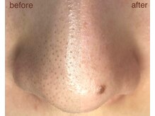 アメアラレ(amearare)/黒ずみ徹底除去コース　1回