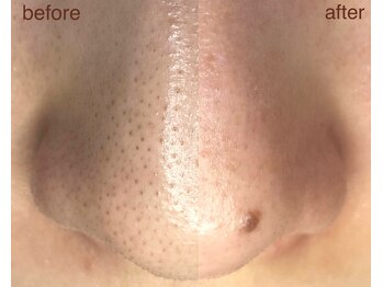 アメアラレ(amearare)/黒ずみ徹底除去コース 1回