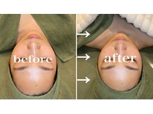 リム(Lim:)/ハイドロ毛穴洗浄◆小顔エステ