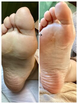 ドクターネイル爪革命 麻布十番店/【角質ケア】フットケア