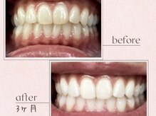 ルアナシンフォニア エクシア 恵比寿店(Luana-Sinfonia)/ホワイトニングビフォーアフター