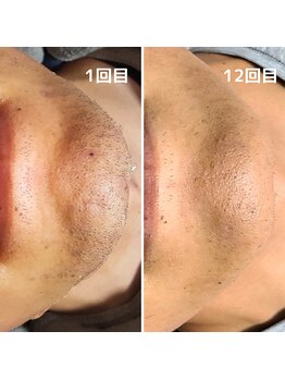 エイプリルプラス(April plus)/美眉　ハリウッドブロウリフト