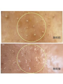 チョチョワンプラス(緒々one+)/鼻の角栓スッキリ♪