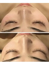 小顔フェイスラボ 桑名店(小顔FaceLabo.)/【オプション】隆鼻矯正