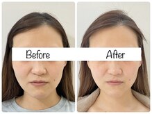 ウニカ(Unica)/Before After