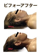 ミクロスポーツ整骨院(MICRO SPORTS整骨院)/【befor/after】50代〔たるみ〕