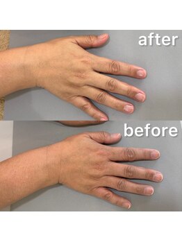 オテテ アイアンドハンド(otete eye&hand)/ハンドケアビフォーアフター