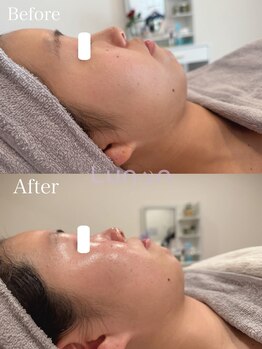 ルノン(Lunon)/毛穴洗浄ハイドロ×ララピール