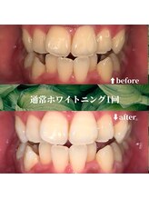 フタバ 天神大名店(futaba)/初回ホワイトニングbefore after