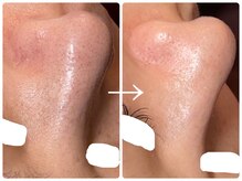 フォーチューン/ハーブトリートメント1回目直後