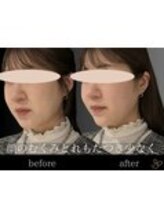 チョコバリ 錦糸町店(chocobari)/小顔×リフトアップ(美容鍼)20代