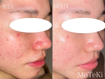 モテキ 表参道店(MoTeKi)/症例Befor/Afterニキビ・肌荒れ