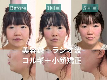 カンワ美容鍼灸院(KANWA美容鍼灸院)/お顔と頬のお肉もたつき・二重顎