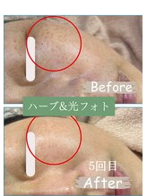 サンテ(Sante)/光フォト×ハーブ