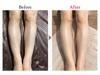 ヨハク(YOHAKU)/20代後半　男性　７回施術