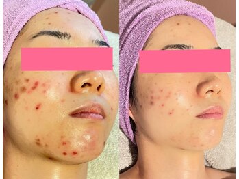 ピュアグレース 自由が丘/エンビロン乳酸ニキビケアコース