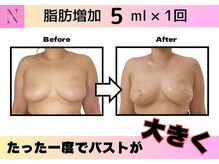 ナチュリ センター南院(NACHUL)/【バスト】NACHULの最新豊胸★