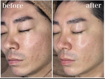 ホワイトアクア 四日市店(WHITE AQUA)/メンズも肌質改善