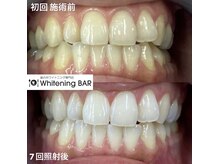 ホワイトニングバー 名古屋栄店/1回で１，２トーンアップが可能