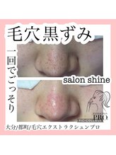 サロンシャイン(Salon Shine)/毛穴エクストラクションプロ