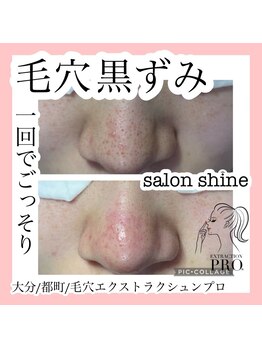 サロンシャイン(Salon Shine)/毛穴エクストラクションプロ