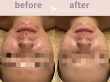 アール(R)/ハーバルメソッド♪