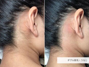 クリード(CLEAD)/うなじダブル脱毛/6000円